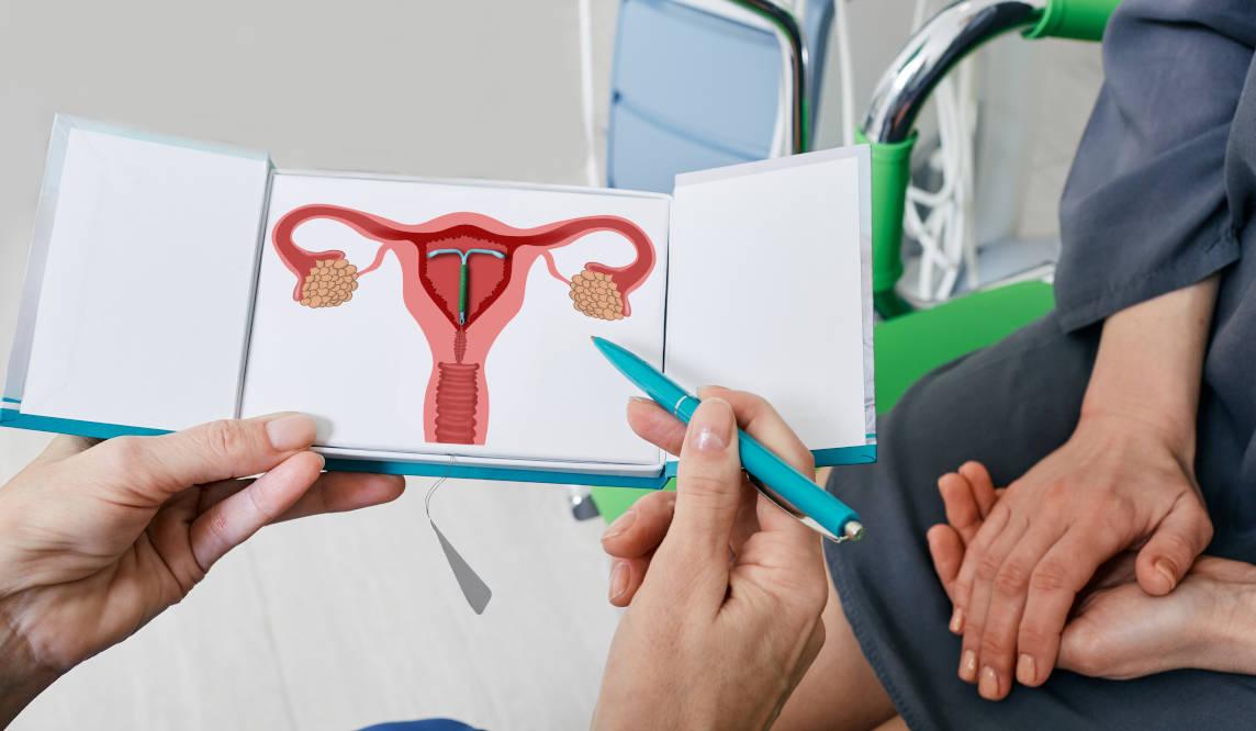 Mengenal 2 Jenis KB IUD: Hormonal dan Non-Hormonal