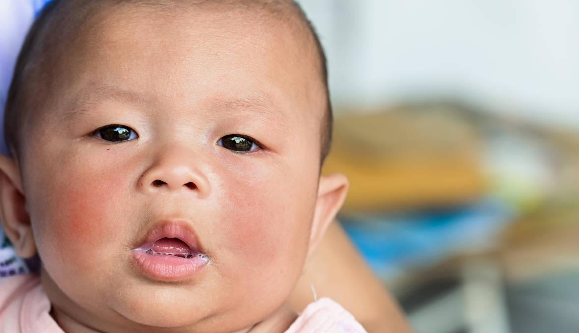 Penyebab Pipi Bayi Merah dan Cara Mengatasinya 